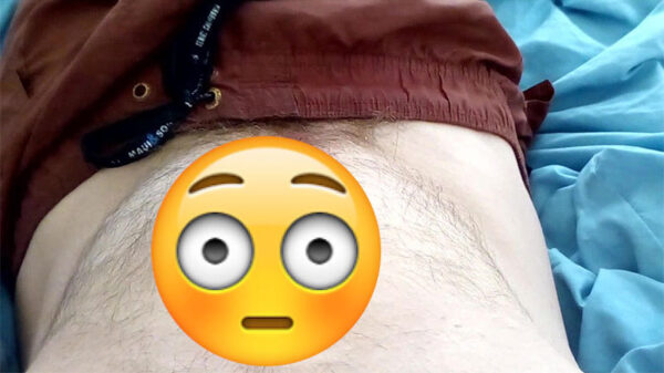 Man heeft bizarre buik na verwijdering van blindedarm