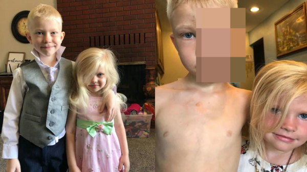 HELD: 6-jarige Bridger Walker onder littekens als hij zijn zusje van een agressieve hond redt
