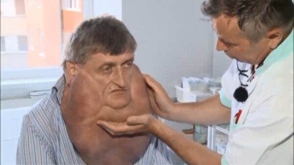 Man met een gigantische onderkin van 6 kg krijgt een metamorfose